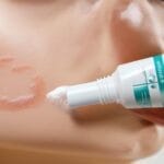 effective azelaic acid treatment